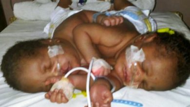 DELSUTH Delivers First Set Of Siamese Twins As Former Delta SSG Urges Nigerians To Fund Surgery