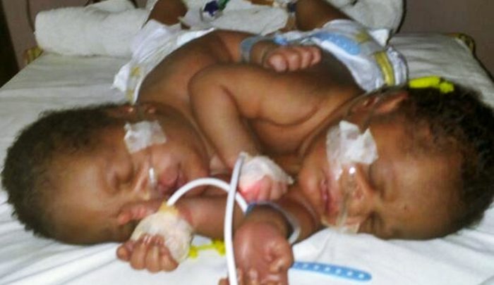 DELSUTH Delivers First Set Of Siamese Twins As Former Delta SSG Urges Nigerians To Fund Surgery