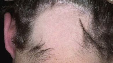 Hair Health: Major Reasons Why Hair Falls Out